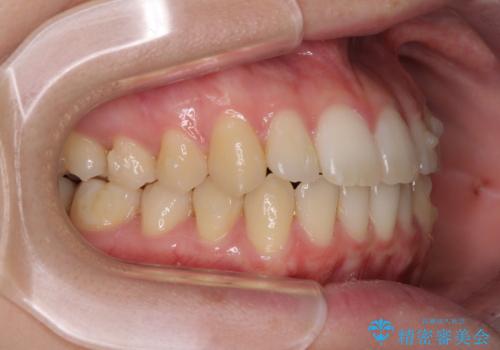 気になる前歯を整えたい インビザライン・ライトでの矯正治療の治療中