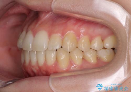 気になる前歯を整えたい インビザライン・ライトでの矯正治療の治療中