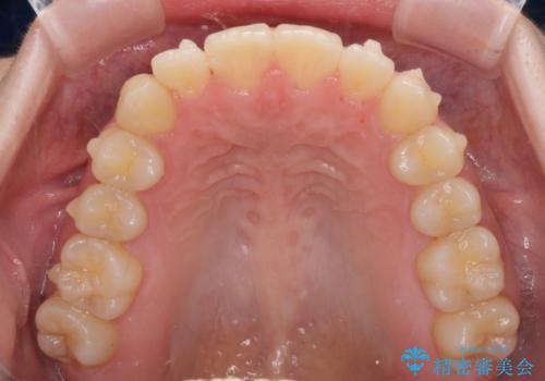 気になる前歯を整えたい インビザライン・ライトでの矯正治療の治療中