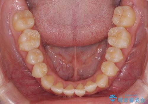 気になる前歯を整えたい インビザライン・ライトでの矯正治療の治療中