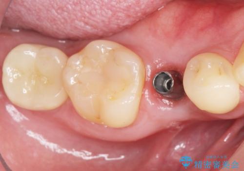 予算を抑えてしっかりとしたインプラント治療 30代男性の治療後