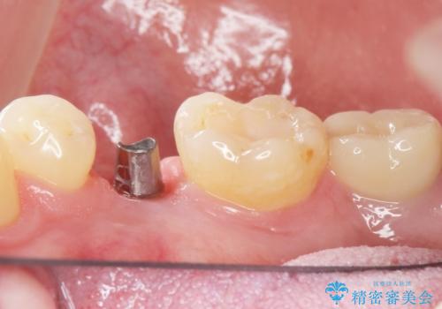 予算を抑えてしっかりとしたインプラント治療 30代男性の治療後
