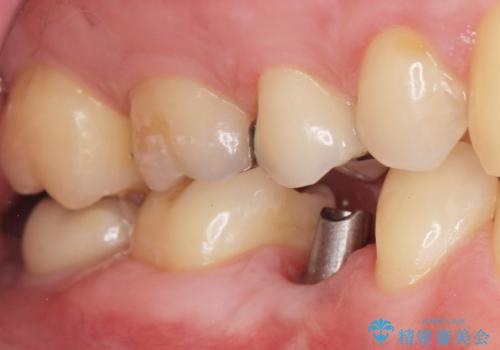 予算を抑えてしっかりとしたインプラント治療 30代男性の治療後