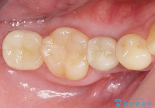 予算を抑えてしっかりとしたインプラント治療 30代男性の治療後
