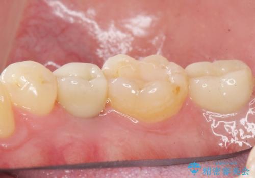 予算を抑えてしっかりとしたインプラント治療 30代男性の治療後