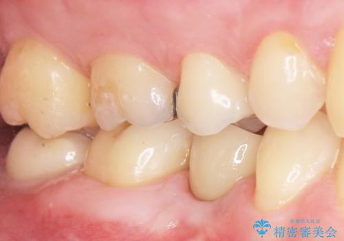 予算を抑えてしっかりとしたインプラント治療 30代男性の治療後