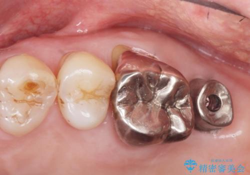 奥歯がわれている ソケットリフトを併用した奥歯のインプラント 60代男性の治療後