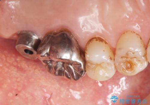 奥歯がわれている ソケットリフトを併用した奥歯のインプラント 60代男性の治療後