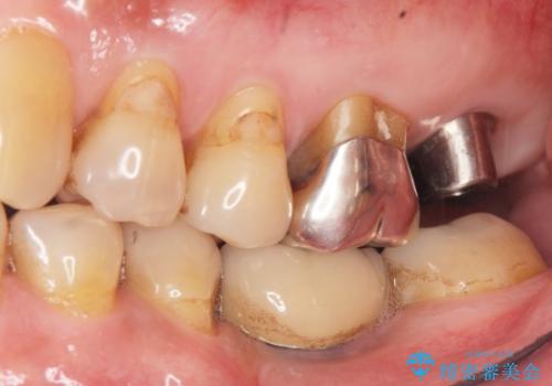 奥歯がわれている ソケットリフトを併用した奥歯のインプラント 60代男性の治療後