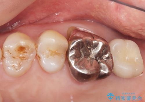 奥歯がわれている ソケットリフトを併用した奥歯のインプラント 60代男性の治療後