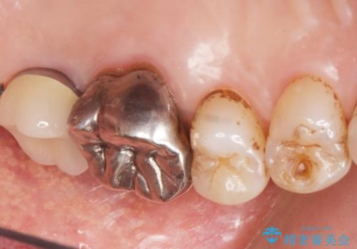 奥歯がわれている ソケットリフトを併用した奥歯のインプラント 60代男性の治療後