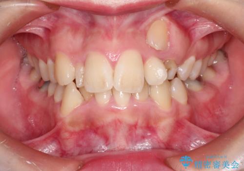 犬歯が変な位置にある　抜歯矯正により正しい位置へ