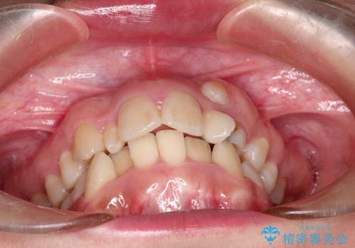 犬歯が変な位置にある　抜歯矯正により正しい位置への治療前