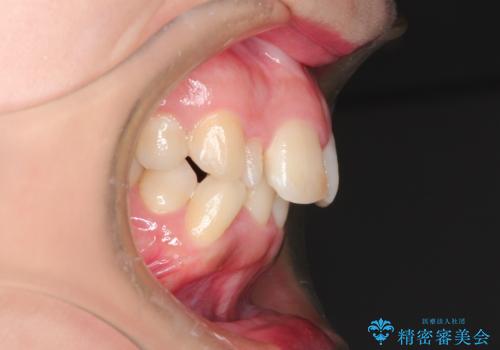 犬歯が変な位置にある 抜歯矯正により正しい位置への治療前