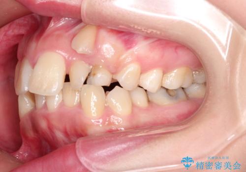 犬歯が変な位置にある 抜歯矯正により正しい位置への治療前