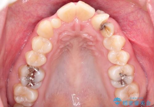 犬歯が変な位置にある 抜歯矯正により正しい位置への治療前