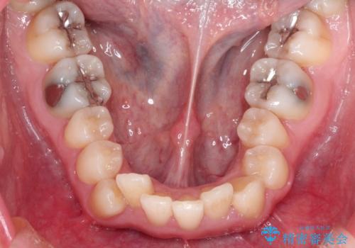 犬歯が変な位置にある 抜歯矯正により正しい位置への治療前