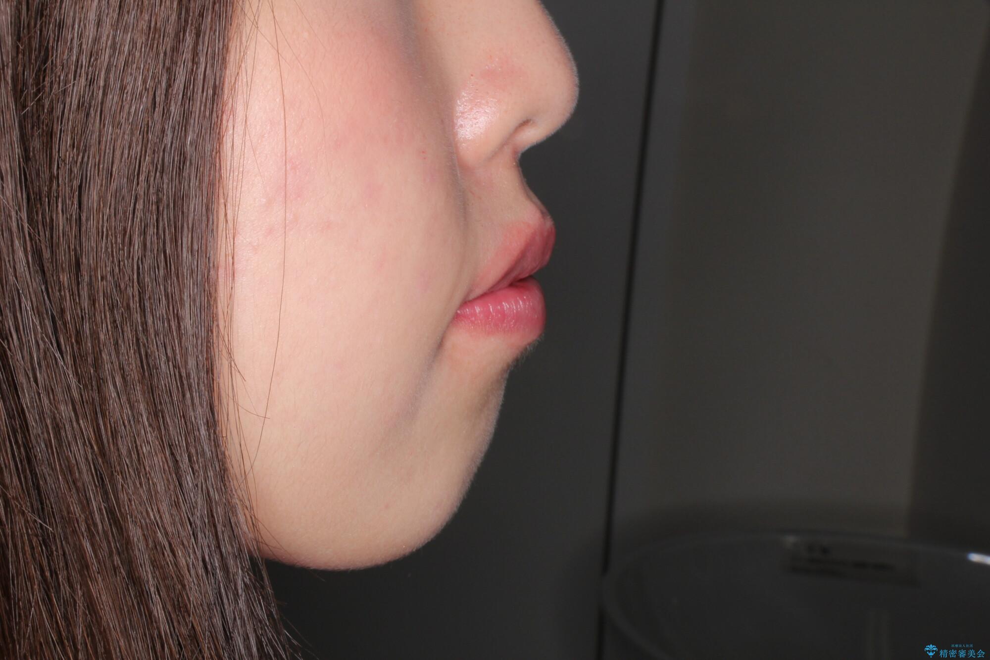 犬歯が変な位置にある 抜歯矯正により正しい位置への治療前(顔貌)