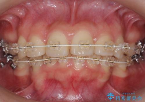 20代女性 出っ歯 口元を引っ込めたいの治療中