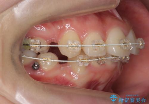 20代女性 出っ歯 口元を引っ込めたいの治療中