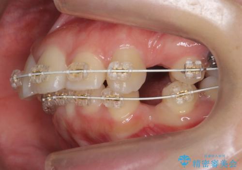 20代女性 出っ歯 口元を引っ込めたいの治療中
