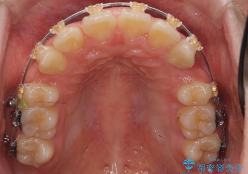 20代女性 出っ歯 口元を引っ込めたいの治療中
