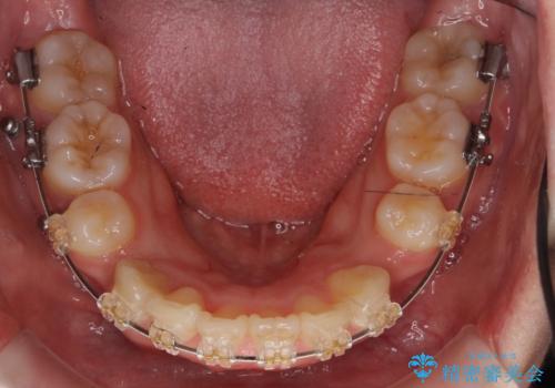 20代女性 出っ歯 口元を引っ込めたいの治療中