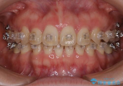 審美装置でワイヤー矯正中の方 ワイヤーを外してPMTCの治療前