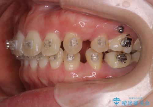 審美装置でワイヤー矯正中の方 ワイヤーを外してPMTCの治療前
