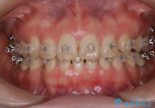 審美装置でワイヤー矯正中の方 ワイヤーを外してPMTCの治療後