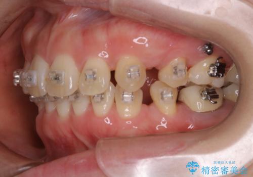 審美装置でワイヤー矯正中の方 ワイヤーを外してPMTCの治療後