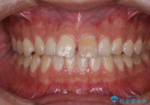 矯正を考えている方のPMTCの治療前