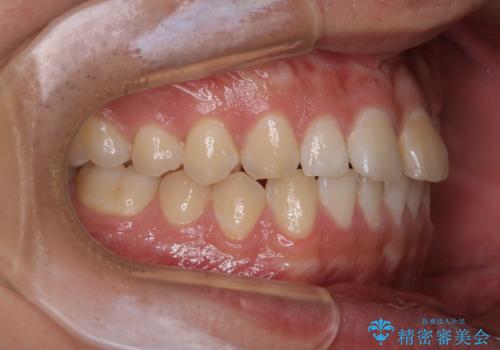 矯正を考えている方のPMTCの治療前