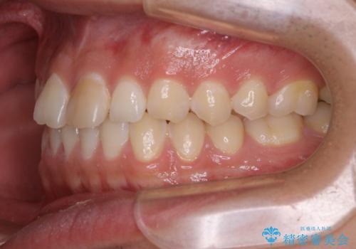 矯正を考えている方のPMTCの治療前