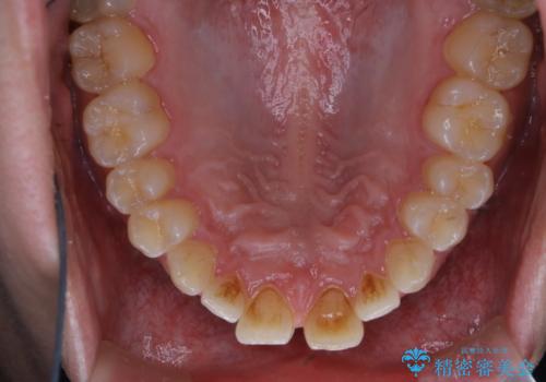 矯正を考えている方のPMTCの治療前