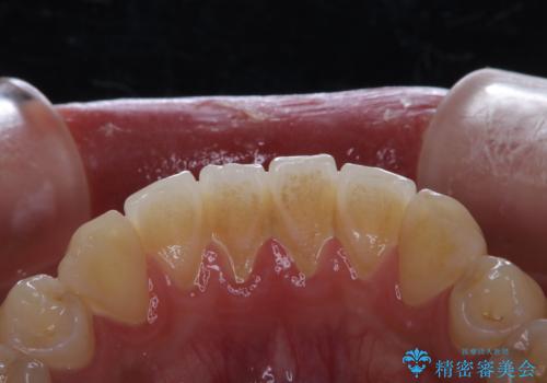 矯正を考えている方のPMTCの治療前