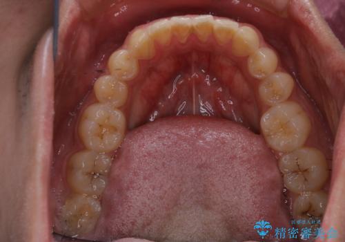 矯正を考えている方のPMTCの治療前