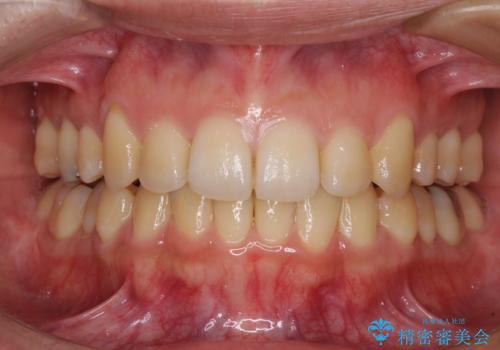 八重歯の抜歯矯正　補助装置を用いたインビザライン矯正