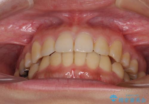 八重歯の抜歯矯正 補助装置を用いたインビザライン矯正の治療後