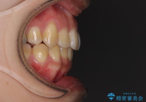 八重歯の抜歯矯正 補助装置を用いたインビザライン矯正の治療後