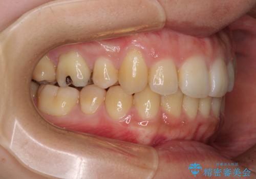八重歯の抜歯矯正　補助装置を用いたインビザライン矯正の治療後