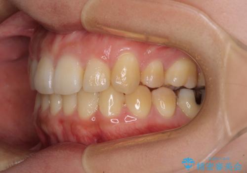 八重歯の抜歯矯正　補助装置を用いたインビザライン矯正の治療後