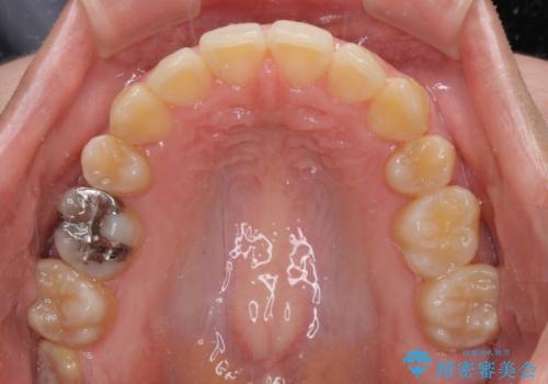 八重歯の抜歯矯正 補助装置を用いたインビザライン矯正の治療後
