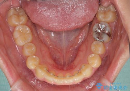 八重歯の抜歯矯正 補助装置を用いたインビザライン矯正の治療後