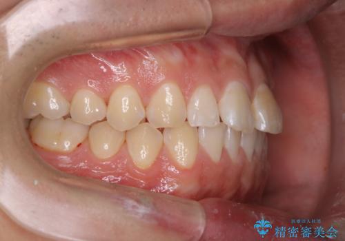 矯正を考えている方のPMTCの治療後