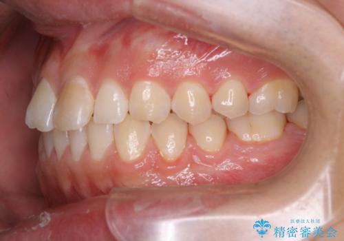 矯正を考えている方のPMTCの治療後