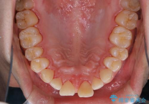 矯正を考えている方のPMTCの治療後