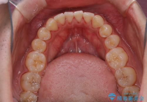 矯正を考えている方のPMTCの治療後