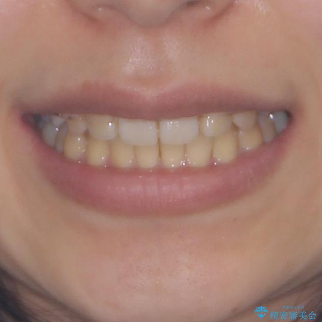 八重歯の抜歯矯正　補助装置を用いたインビザライン矯正の治療後（顔貌）