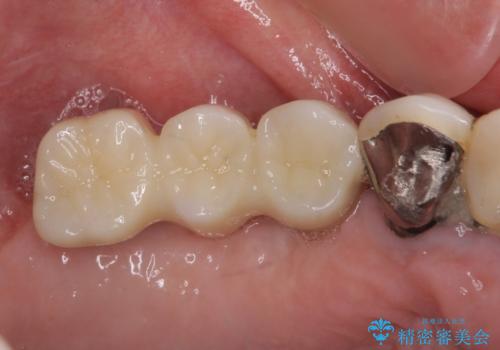 上顎奥歯の欠損をインプラントで補綴治療の症例 治療後